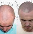Tatuagem que simula cabeça raspada se torna a salvação dos carecas que perderam a autoestima  Foto: Vinci Hair Clinic / Divulgação