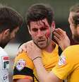 Michael Timlin sofreu corte profundo em partida neste domingo  Foto: Jamie McDonald / Getty Images