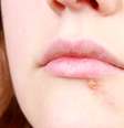 A laserterapia pode ajudar tanto no tratamento quanto na prevenção do herpes reduzindo o período de manifestação da doença e aliviando a dor  Foto: Berents / Shutterstock