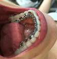 Colocados atrás dos dentes, em contato com a língua, o custo desse tipo de tratamento chega a ser até quatro vezes maior do que o feito com um aparelho convencional
  Foto: Divulgação