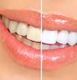 Clareamento em consultório, caseiro ou com cremes dentais branqueadores podem ajudar a iluminar o sorriso de forma segura  Foto: kurhan / Shutterstock
