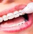 Para modificar a posição dos dentes, é preciso que ocorra um deslizamento entre os braquetes e o fio, o que não acontece se o aparelho estiver sujo  Foto: unpict / Shutterstock
