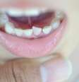 Uma forma de evitar sofrimento e futuros traumas é deixar o dente cair sozinho, sem arrancá-lo ou forçá-lo drasticamente  Foto:  ARZTSAMUI  / Shutterstock