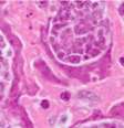 Pequenos tecidos cancerígenos de vermes estavam crescendo no paciente  Foto: CDC / BBC News Brasil