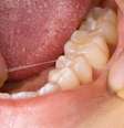 O dente do siso é o último a se formar, por volta dos nove anos de idade, e por isso nasce mais tarde, entre os 17 e 20 anos  Foto: hightowernrw / Shutterstock