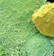 Levantamento mostrou que 10 cm a mais na circunferência abdominal aumentariam as chances de desenvolver tipo mais agressivo da doença em 13%.  Foto: Science Photo Library / BBCBrasil.com