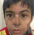 O nariz de Arun Patel ficou desfigurado após uma pneumonia  Foto: S Niazi / BBC News Brasil