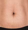 Estrias não aparecem apenas na pele das mulheres   Foto: iStock
