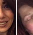 Duas fotos de Alison Morton. Em uma delas, a mulher está bem. Na seguinte, tirada poucas horas depois, está com muita dor.  Foto: BBC News Brasil