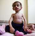 Bebê de dois anos sofre com escassez de alimentos em Ghouta, na Síria  25/10/2017 REUTERS/Bassam Khabieh   Foto: Reuters