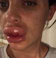 Rachael Knappier não saiu de casa por uma semana depois que seus lábios incharam muito por causa de um erro na aplicação de preenchimento labial.  Foto: Rachael Knappier / BBC News Brasil