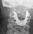 Médicos encontraram dentadura de homem em sua garganta oito dias após cirurgia no abdômen  Foto: BMJ Case Reports 2019 / BBC News Brasil
