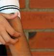 Em estudo do King's College London, no Reino Unido, 21% das pessoas disseram que sinais dermatológicos foram os únicos sinais clínicos da covid-19  Foto: Getty Images / BBC News Brasil