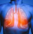 Covid-19 pode deixar problemas crônicos nos pulmões e outros órgãos, como a fibrose pulmonar  Foto: Getty Images / BBC News Brasil