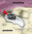 A imagem mostra um axônio de um neurônio do cérebro de uma criança com síndrome inflamatória multissistêmica pediátrica (SIM-P). A seta aponta o vírus SARS-CoV-2 em uma vesícula no citoplasma do axônio  Foto: Elia Caldini / BBC News Brasil