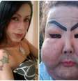 A transexual Juju Oliveira antes e depois da aplicação com finalidade estética que deformou seu rosto  Foto: 