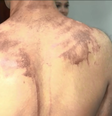 Calouro mostra as queimaduras sofridas após trote com substância química no Paraná  Foto: Reprodução/Catve.com
