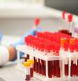 Entenda o que é a leucemia  Foto: Shutterstock / Saúde em Dia