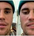 Síndrome de Ramsay Hunt  Foto: Reprodução Instagram @justinbieber / Saúde em Dia