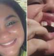 Andressa Hailer teve dentes quebrados e freio costurado na gengiva durante cirurgia  Foto: Reprodução/Arquivo pessoal