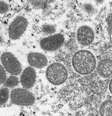 Imagem de microscópio eletrônico mostra sinais da varíola dos macacos em uma amostra de pele humana  Foto: CDC 
