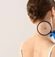 Melanoma  Foto: Shutterstock / Saúde em Dia