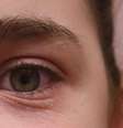 Rinite: pregas abaixo dos olhos está entre os sintomas da alergia  Foto: Shutterstock / Saúde em Dia