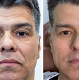 Antes e depois do ator e cantor Maurício Mattar, de 58 anos  Foto: @draelidamoret / Reprodução/Instagram