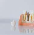 A colocação de um implante dental é um procedimento cada vez mais comum   Foto: Pexels