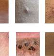 Possíveis lesões de monkeypox.  Foto: Reuters / BBC News Brasil