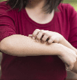 Dermatite atópica  Foto: Shutterstock / Saúde em Dia