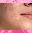 Veja as diferenças entre acne e rosácea  Foto: Freepik / todateen