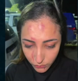 Soraya Oliveira mostra hematomas após sofrer agressão   Foto: TV Jornal