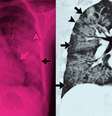 Imagem de raio X e tomografia computadorizada de paciente com lesões (setas brancas e pretas) provocadas pelo uso de cigarros eletrônicos   Foto: Sociedade de Radiologia da América do Norte