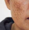 Melasma: máscara facial reduz as manchas escuras  Foto: Shutterstock / Saúde em Dia