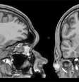 Ressonância magnética mostrando locais de eletrodos medial-temporais em um paciente representativo  Foto: Departamento de Cirurgia Neurológica, Universidade de Chicago