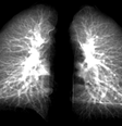 Pesquisadores criaram um modelo avançado de raio-x que pode detectar danos pulmonares em pacientes com covid longa   Foto: 