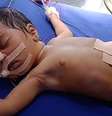Bebê passou por cirurgia para retirada de embriões  Foto: Reprodução/Mail Online Health