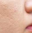 Cicatrizes de acne cuidados  Foto: Shutterstock / Alto Astral