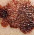Pinta típica de um melanoma  Foto: Getty Images / BBC News Brasil