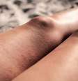 O suor e a umidade acabam piorando o atrito entre as pernas -  Foto: Shutterstock / Alto Astral