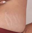 Estrias brancas são as cicatrizes mais difíceis de tratar -  Foto: Shutterstock / Alto Astral