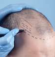 Especialista esclarece 6 mitos e verdades transplante capilar  Foto: Shutterstock / Saúde em Dia