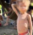 Criança yanomami com sinais de desnutrição  Foto: Associação Médicos da Floresta / BBC News Brasil