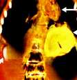Imagem de tomografia mostra o coração de ouro da múmia  Foto: Cortesía S.N. Saleem, S.A. Seddik, M. el-Halwagy / BBC News Brasil