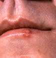 Manifestações do herpes começam com um inchaço e vermelhidão nos lábios, como se formasse uma bolha (Imagem: CDC/Dr. Hermann)  Foto: Canaltech
