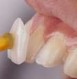 Lente de contato dental realmente desgasta os dentes? Entenda -  Foto: Shutterstock / Saúde em Dia