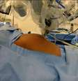 SAO PAULO METROPOLE 02 Julho 2016 ROBO HOSPITAL OSWALDO CRUZ Brasil testa robô para remover câncer de útero com incisão única Mulher de 41 anos com tumor em estágio inicial teve útero, trompas e gânglios linfáticos retirados com sucesso na última quarta-feira FOTO HOSPITAL OSWALDO CRUZ  Foto: DIVULGAÇÃO / Estadão