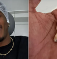 No que diz respeito à recuperação, não muda muito tirar dois de cada vez ou quatro  Foto: Reprodução