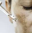 Entenda o que é melasma e como cuidar da pele.  Foto: iStock